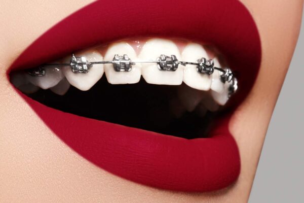 Dental Braces in dubai