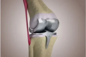 The TKR Operation: Relief for Severe Knee Arthritis